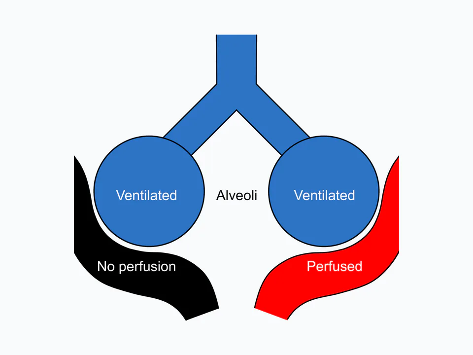 alveoláris ventiláció: A nagy felbontású ábra az alveoláris holtteret — a ventilált, de gázcserében nem hatékony alveoláris egységet — emeli ki, így szemlélteti, hogy a belélegzett levegőnek csak egy része járul hozzá a tényleges alveoláris ventilációhoz.